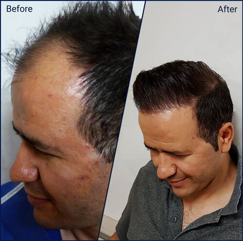 Hair transplant in Iran + costs and methods