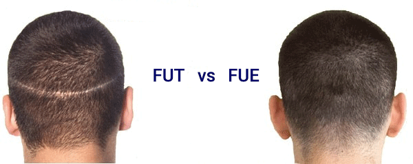 FUT vs FUE